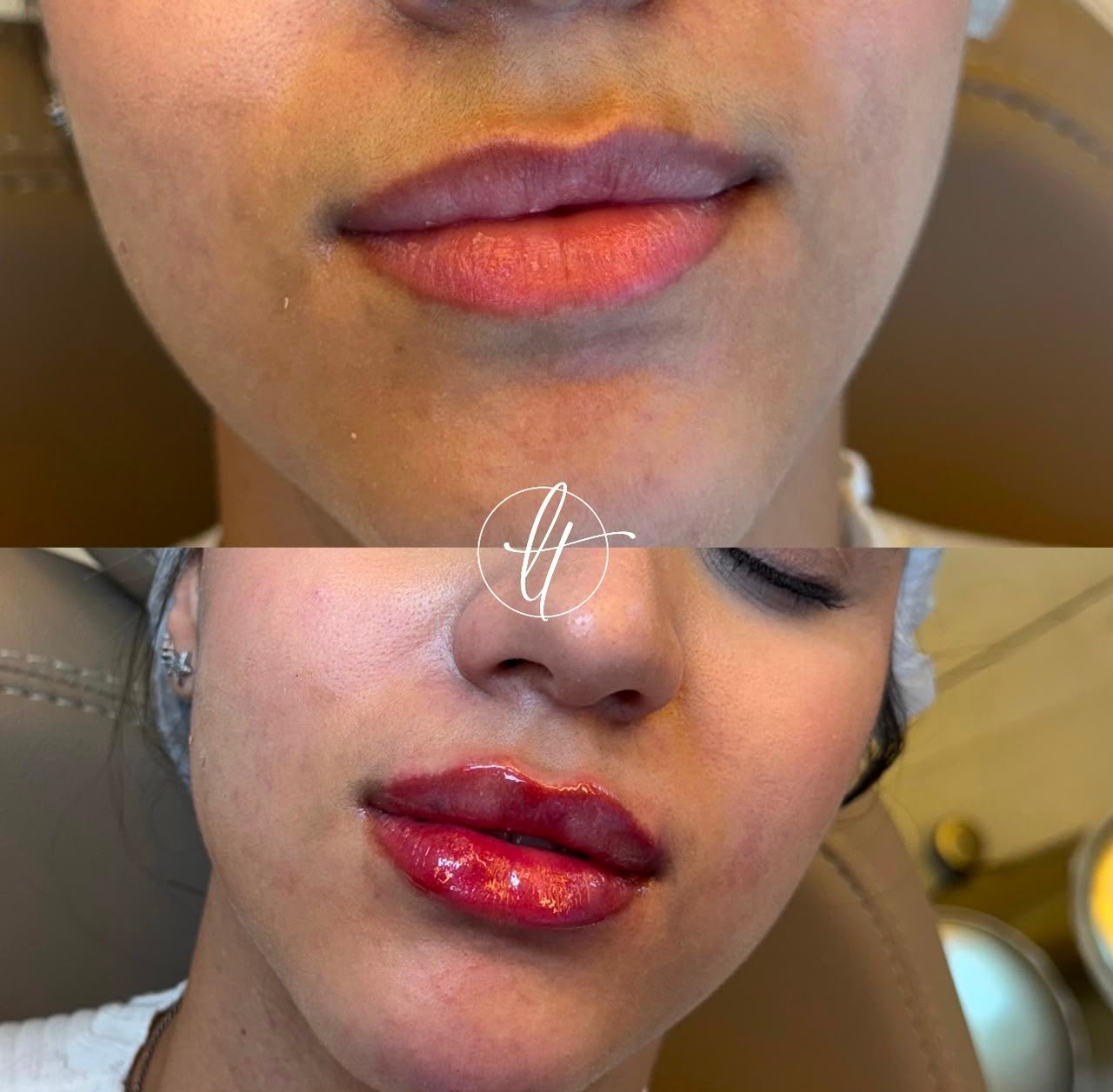 Antes e depois de preenchimento labial — caso 2